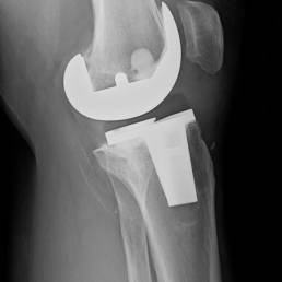 Avances en cirugía ortopedica: Lo último en tecnología y técnicas